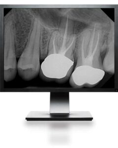 monitor-xray-straight-on DentiMax Dental Digital X-Ray Technology