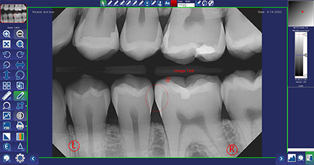Annotate dental X-ray images inside of DentiView imaging software