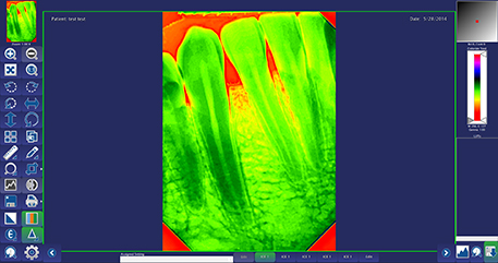 Colorized dental X-ray image feature with DentiView software