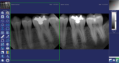 Compare dental X-ray images with DentiView imaging software