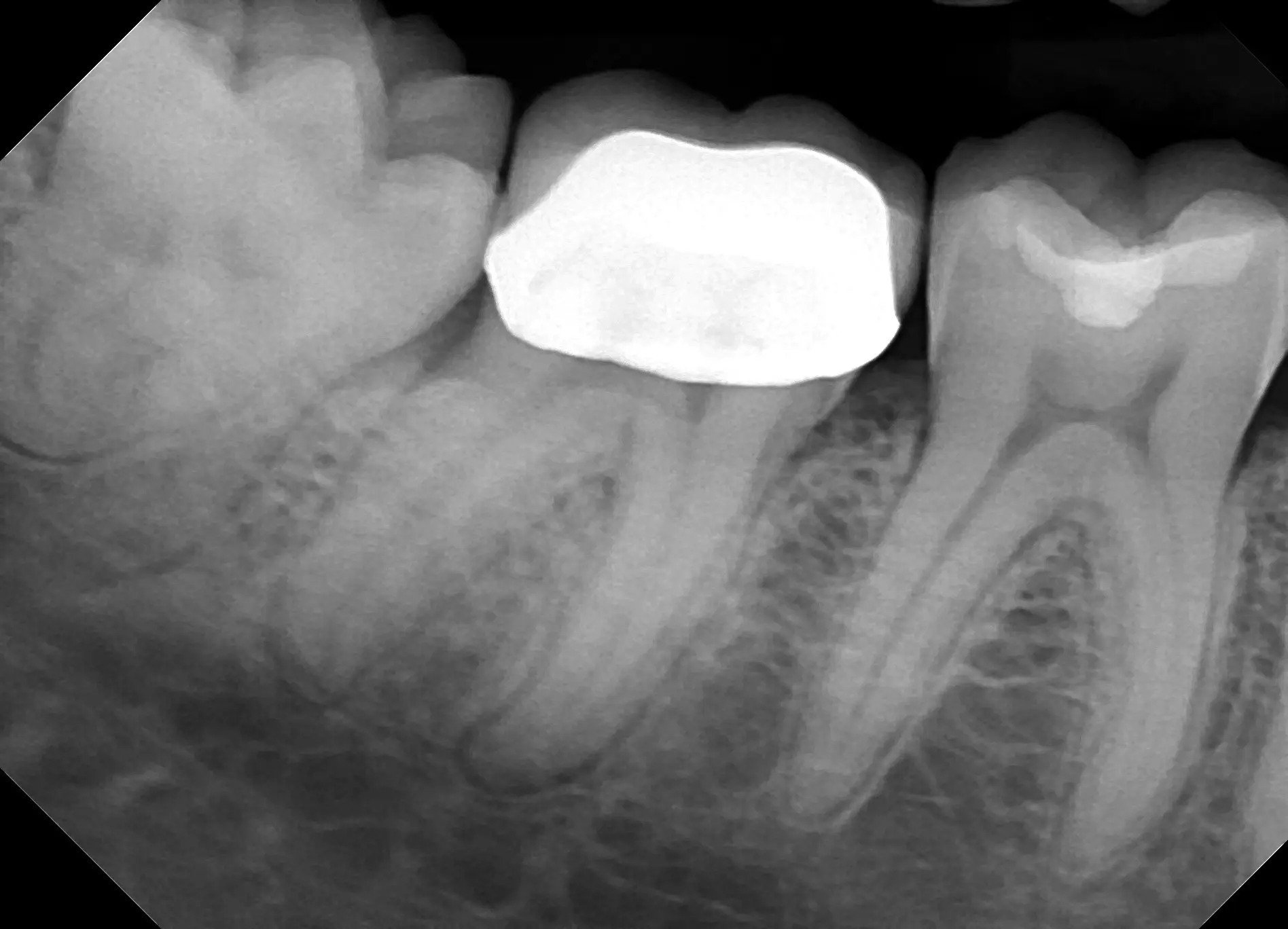 Affordable High Quality Dental Sensors DentiMax Dream Sensor