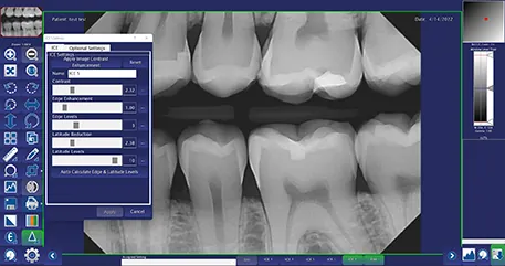 Image Sharpening Tool in DentiView X-Ray imaging software